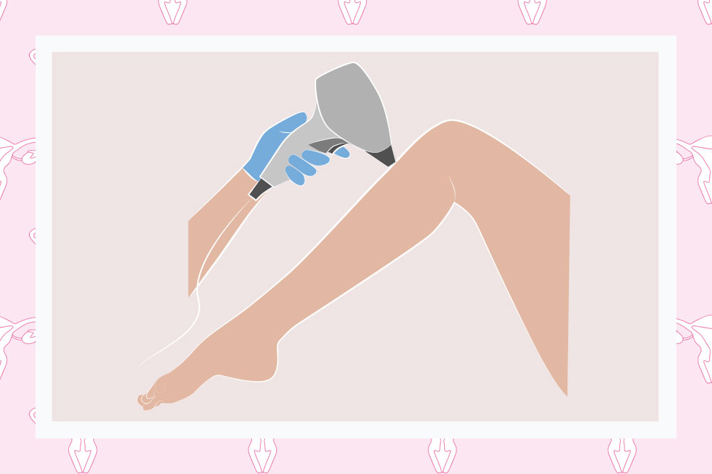 Everything you need to know about PCOS and laser hair removal