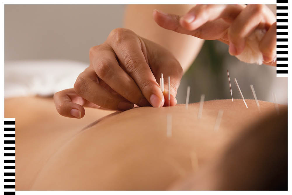 Is Acupuncture the key to achieving wellness today?