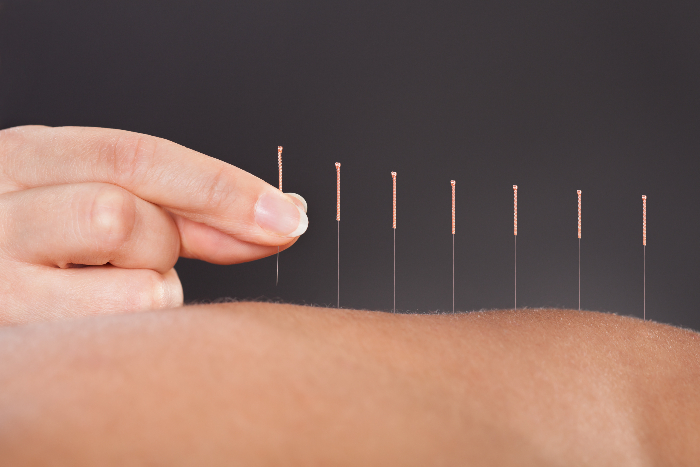 Acupuncture for Kids: A Handy Guide